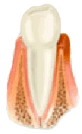 Gingivitis - Periodoncia, Clínica Dental Sabatés