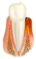 Periodontitis inicial- Periodoncia, Clínica Dental Sabatés